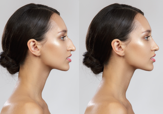 Rhinoplastie resultat long terme